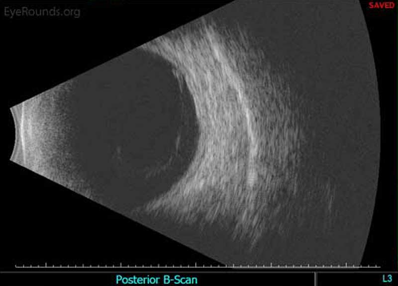 Standardized ocular echography of the left eye shows a highly visible, complete posterior vitreous detachment (PVD)
