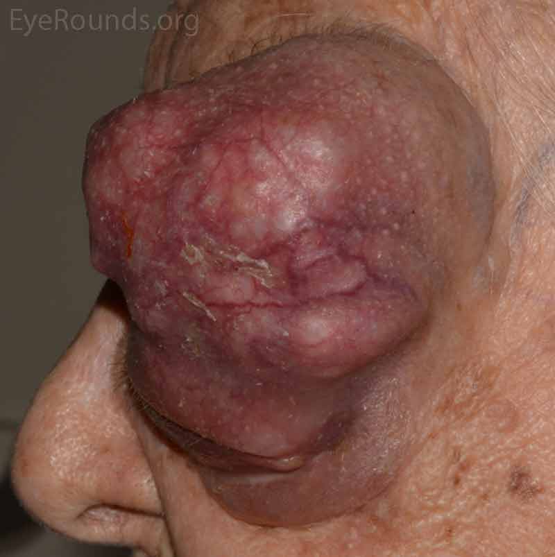 External photos demonstrates a large 9cm x 8cm mass extending from the supraorbital area with inferonasal displacement of the globe. The lesion is irregular and the overlying skin is erythematous. There is limited view of the left globe, which is displaced inferonasally. 