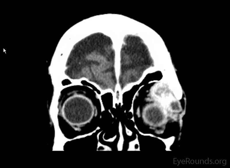 Coronal, frontal, and sagittal views from CT maxillofacial with contrast at the time of initial presentation. The CT demonstrates a left orbital mass displaying both solid enhancing and cystic components. The epicenter of the mass appears to be in the left lacrimal gland. There is left proptosis with medial displacement of the optic nerve and extraocular muscles. There is no definite sign of osteolysis of the orbital walls, however, there is bone remodeling with depression of the orbital floor. No evidence of intracranial extension of the left orbital mass.