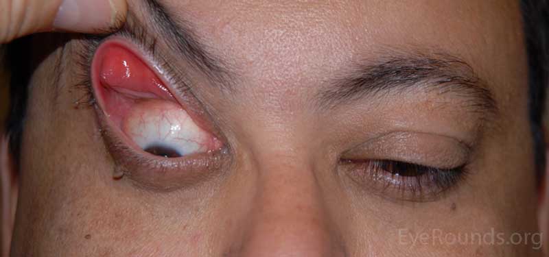OD: lateral ptosis, significant eversion of the upper eyelid with minimal upward traction; significant lower eyelid laxity 