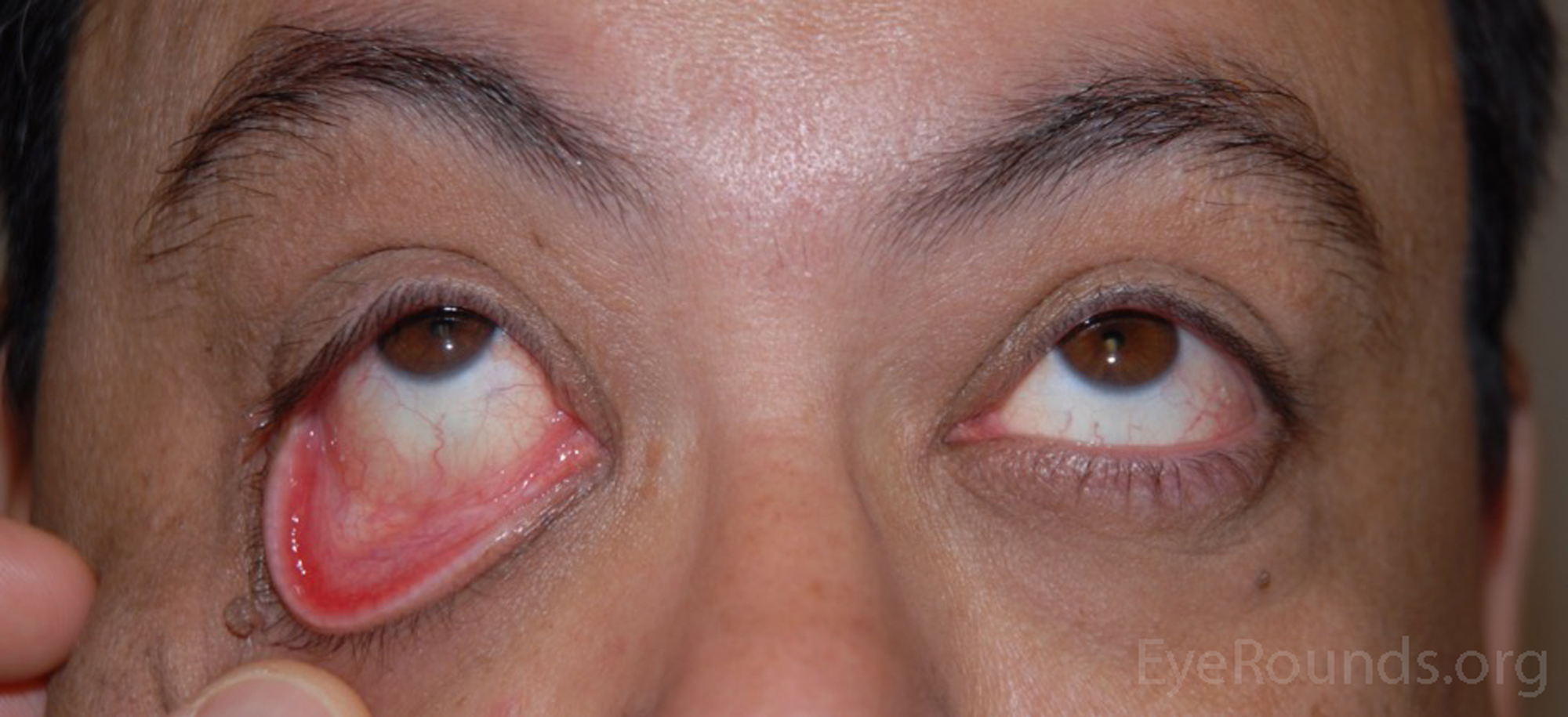 Featured image of post Eyelids Flipped Inside Out Antibiotic treatments help get rid of such infections