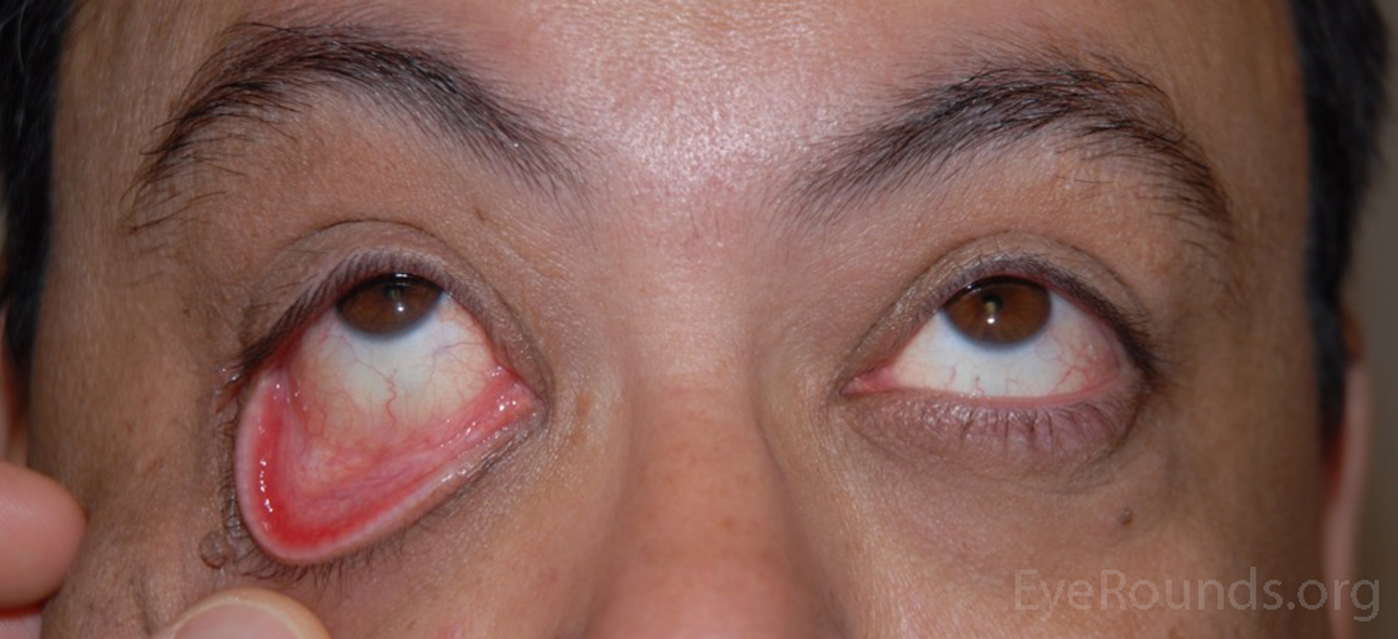 drooping lower eyelid