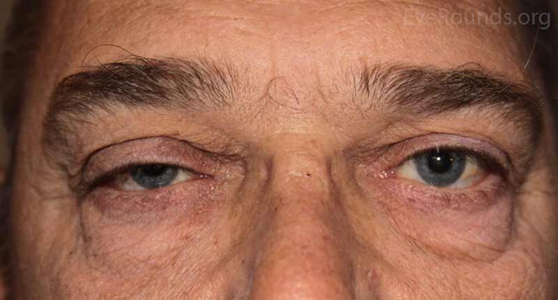 OD: Ptosis, significant eversion with gentle traction on the upper eyelid