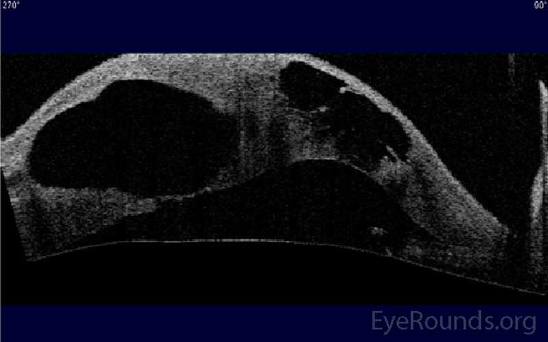 Figure 3: AS-OCT showing large, cystic intrastromal accumulation of fluid in a patient with keratoconus and acute corneal hydrops.