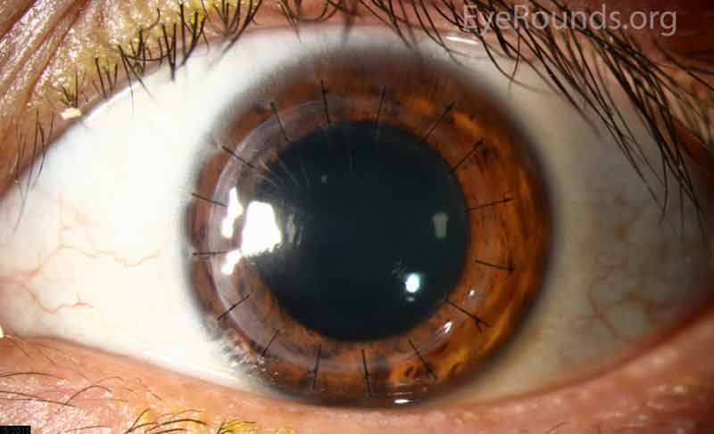 Figure 4: Penetrating keratoplasty performed for keratoconus