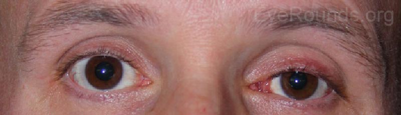 External photo showing left lid ptosis and left eye caruncular lesion.