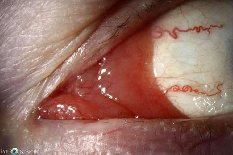 Slit lamp photo showing salmon colored patch with telangiectatic vessels in caruncle of left eye.