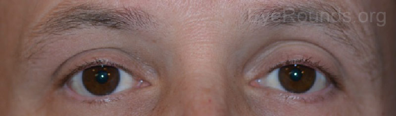External photos showing resolution of ptosis four months following radiation treatment to the right eye lesion and eleven months after completing radiation to the left eye lesion.