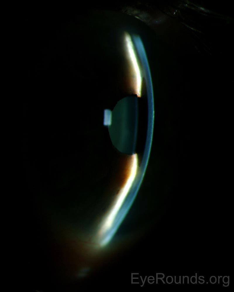 Slitlamp photo OS (Photographer Brice Critser): Using the slit beam to assess anterior chamber depth, there is iridocorneal touch peripherally with approximately two corneal thicknesses deep centrally. The iris does not have the bombé configuration and the anterior chamber is diffusely shallow.