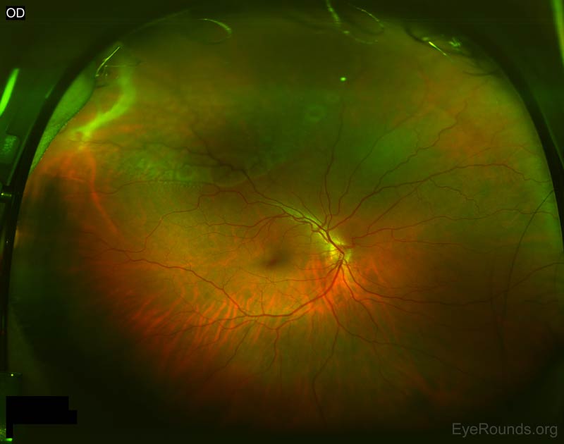 Figure 3: Outer retinal holes in the setting of superotemporal retinoschisis.