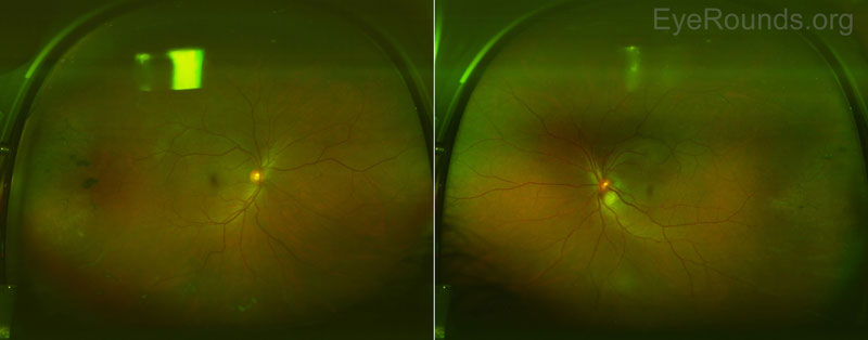 Figure 2: Optos color fundus photography. The media appeared slightly hazy in both eyes due to mild vitritis. The right optic nerve was healthy with no disc edema. There was mild disc edema of the left optic nerve and a large (~2000mm) inferotemporal retinal granuloma with surrounding subretinal fluid tracking into the macula.  There were snowballs present inferiorly OU, which were difficult to appreciate in these images.  There were chorioretinal scars with pigment temporally and inferiorly OU.