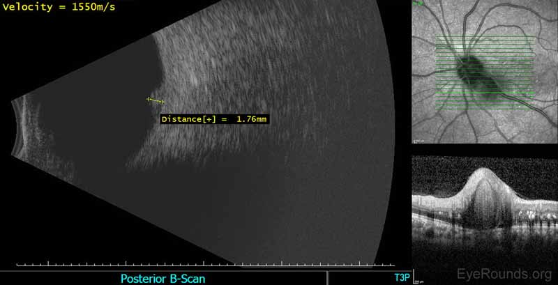 Figure 3: Echography of the left eye. Mild to moderate vitreous opacities. Just temporal to the optic disc (peripapillary), there was an elevated, high reflective lesion in the outer retina. Maximum elevation was 1.7mm. There was no retinochoroidal layer thickening elsewhere or retinal detachment detected.