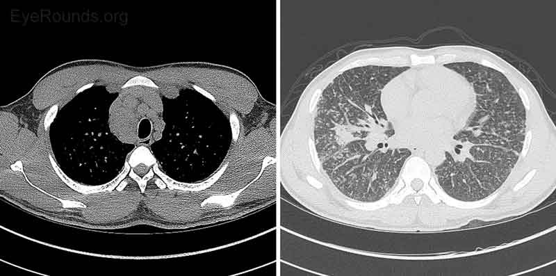 Figure 6: CT Chest without contrast. Diffuse lymphadenopathy was present and nonspecific, but given the diffuse nature was most consistent with systemic disease such as sarcoid or lymphoma. Diffuse prominence of bronchovascular interstitium with associated nodularity was nonspecific. More focal consolidation in the right middle lobe, tree-in-bud nodularity in the inferior right upper lobe, and centrilobular ground-glass nodules suggested more acute inflammatory bronchial process, such as bronchitis. Although a CT pattern of alveolar sarcoid can present with ground-glass opacities, the pattern the patient presented with was more typical of centrilobular bronchitis.