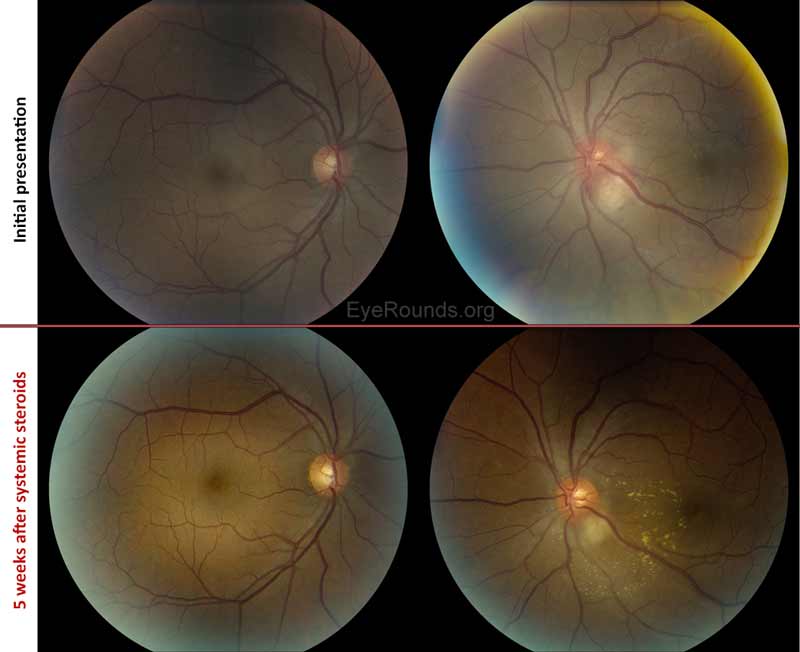 Figure 8: Color fundus photography before and after steroid treatment. On initial presentation, the patient was admitted for the treatment of acute granulomatous panuveitis OU and disc granuloma OS (Panel A). Oral prednisone was initiated at 60mg per day. The patient's systemic steroids were tapered slowly over several months (60mg x 1 month, 40mg x 1 month, 30mg x 1 month). The optic nerve granuloma OS decreased in size after five weeks of prednisone therapy (Panel B). At the follow-up visit, macular exudates were present in the left eye as a result of prior long-standing subretinal fluid OS.