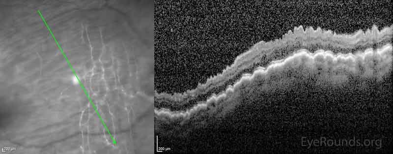 Figure 6:  OCT during post-operative course showing worsening macular hypotony as compared to presentation OCT (Figure 4) 