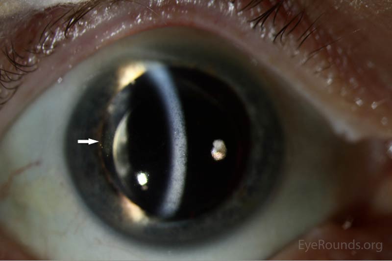 Figure 2: Slit Lamp photos of both eyes reveal pigmented keratitic precipitates (arrows) 