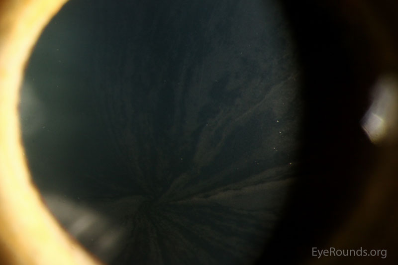 Figure 2: Slit lamp photos of the left eye exhibiting the whorled pattern of corneal verticillata
