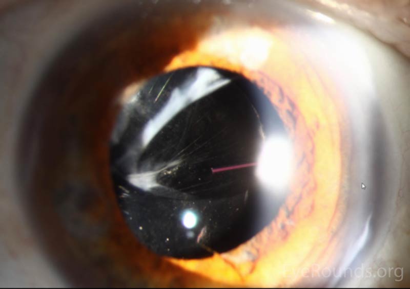 Figure 2: Slit lamp photographs (A, B, and C) showing superior dislocation of a 3-piece posterior chamber intraocular lens within the capsular bag. Capsular phimosis is most notable superonasally in A and B. Retroillumination is used in C to show the dislocated lens, iris atrophy, and intraocular cilium at 6 o'clock. Also evident is the posterior capsule opacification.