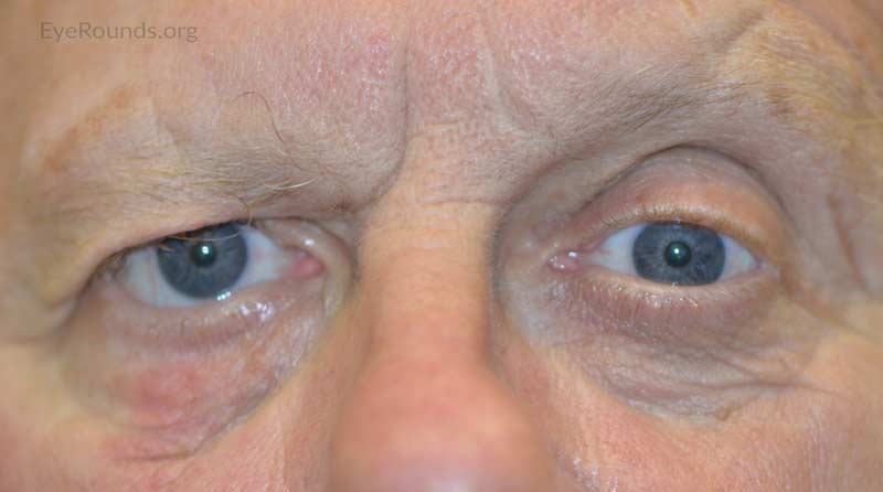 External photo demonstrates right-sided facial droop, brow ptosis, and lower eyelid ectropion.