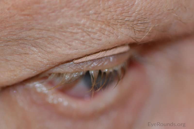 Lateral view of right eyelid with BlinkEze® eyelid weight in place.