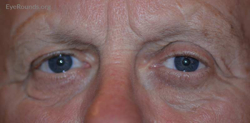 External photo at 10 month post-operative visit showing mild residual right brow ptosis and lower eyelid ectropion.