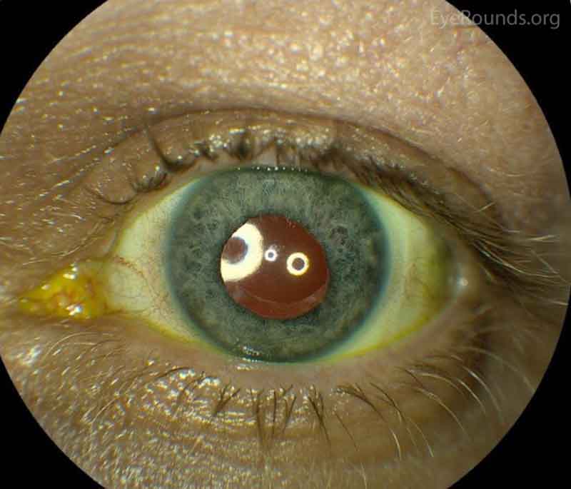 Figure 1: Color and infrared transillumination photos of the left eye. Multiple radial transillumination defects of the iris as well as circumferential defects that match the shape of the IOL haptics.