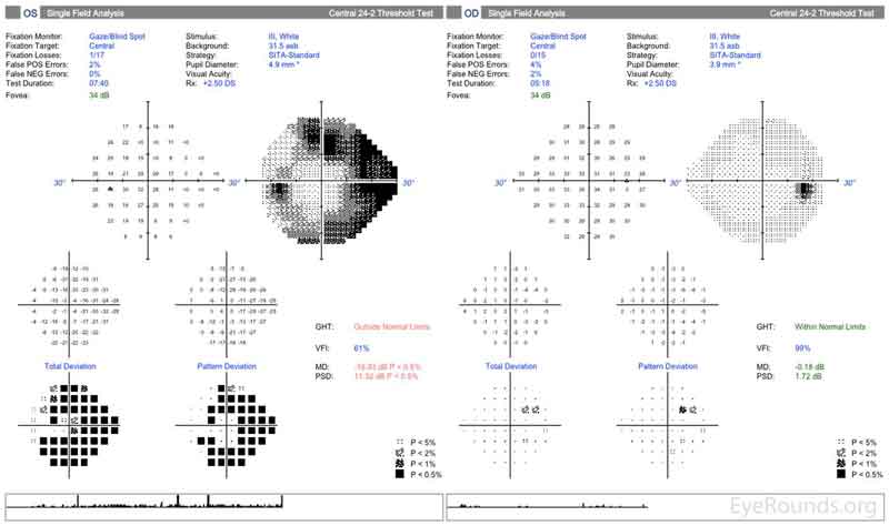 Figure 2: Humphrey Visual Fields (24-2). Left image: Normal visual field OD with good test reliability. Right image: Good test reliability with evidence of severe stage glaucoma with superior and inferior arcuate scotomas OS.