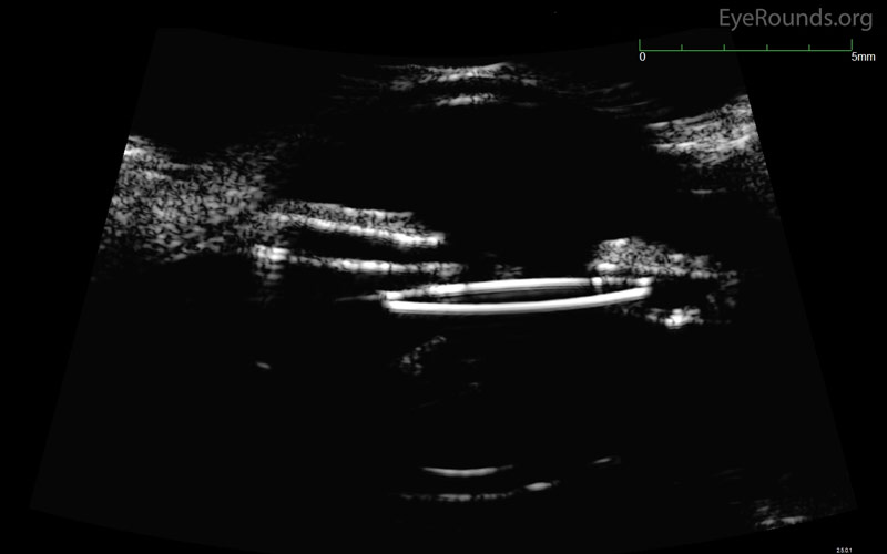 Figure 4: Ultrasound biomicroscopy of the left eye. The nasal optic of an IOL is seen abutting the posterior iris surface in a patient with UGH syndrome.
(Note: Figure 4 was obtained from a different patient and is used in this case for illustration.)