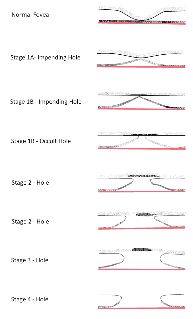 This figure demonstrates the stages of macular holes based on the 1995 paper by J. Donald M. Gass.(9) This figure shows the range of pathology between cystic changes (Stage 1) to full thickness defects with a complete posterior vitreous detachment (Stage 4)