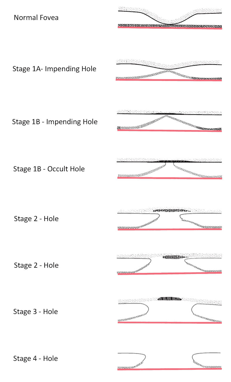 macular hole