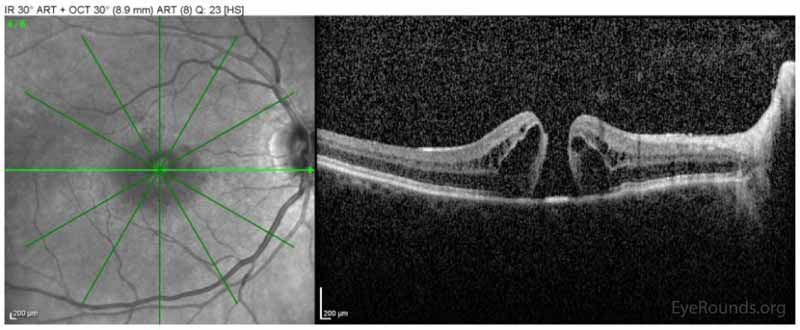 Spectralis ocular coherence tomography (OCT) of the macula OD on initial presentation demonstrating the presence of a full-thickness macular hole with interstitial and subretinal fluid. 