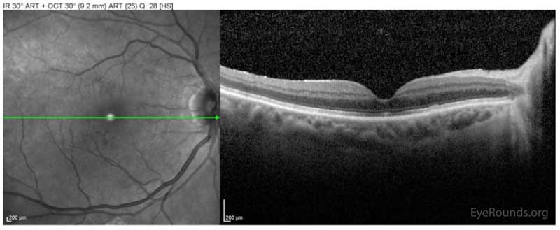 Spectralis OCT of the macula OD at the one-month post-operative visit demonstrating interval closure of the macular hole.  