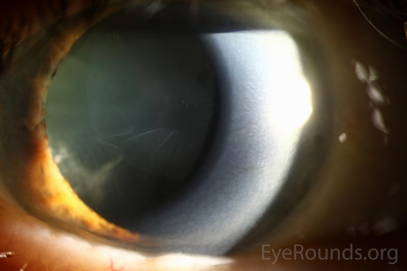 Slit lamp photograph OD demonstrating delamination of the anterior lens capsule with wrinkling of the free-floating flap in the anterior chamber.