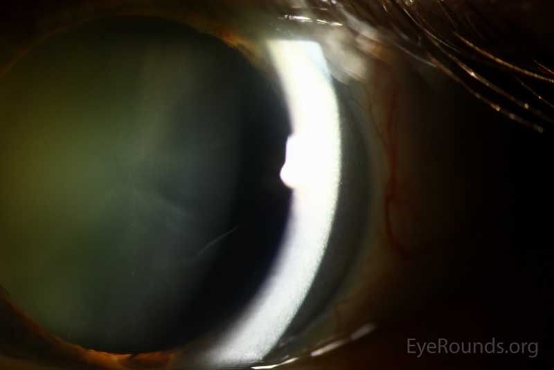Slit lamp photograph OS demonstrating bilateral disease with the floating rolled edge of the delaminated flap of anterior lens capsule.