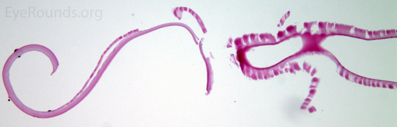 Two images of the anterior lens capsule OS (H&E stain on the top and PAS stain on the bottom image). Both stains clearly demonstrate delamination of the anterior lens capsule with the flap attachment point and breakdown of the anterior delaminated portion.