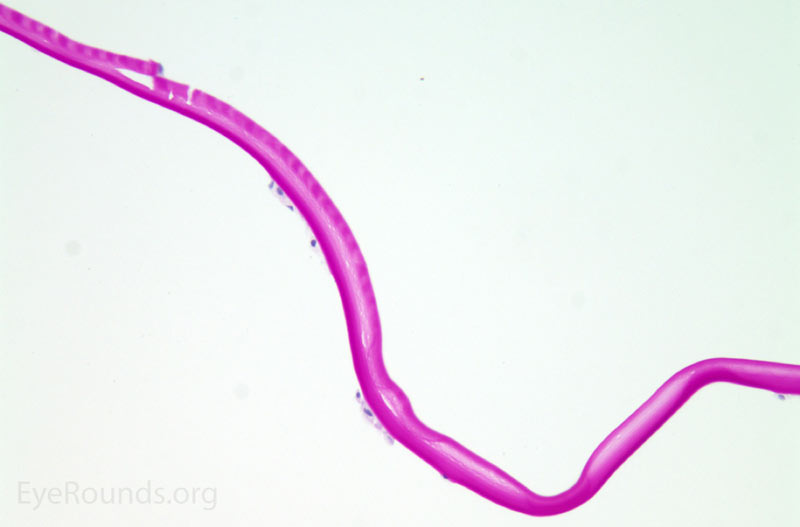 PAS staining of the anterior lens capsule from the left eye showing early delamination of the anterior capsule with schisis cavities forming and beginning to coalesce.