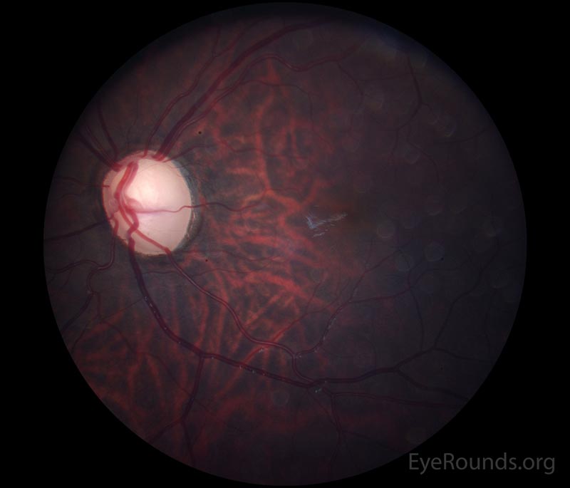 Color fundus photos of left eye (A) Cup-to-disc ratio of 0.9 at age 15 and (B) Cup-to-disc ratio of 0.9 at age 20.