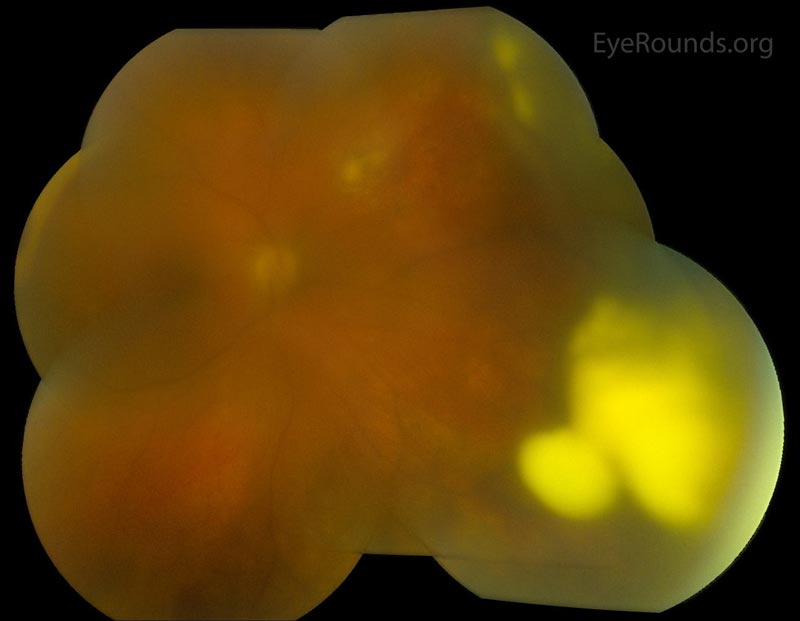 Color fundus photo montage demonstrating consolidation of the nasal vitreous opacities with resolution of the opacities overlying the optic disc. 