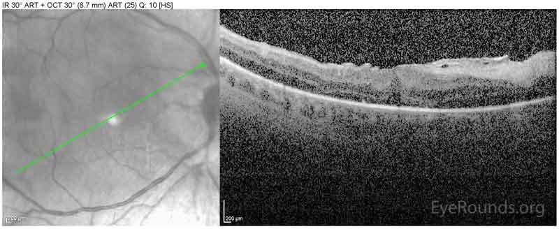 Spectral-domain OCT obtained the same day as the above photograph demonstrating development of an epiretinal membrane with distortion of the foveal contour. 
