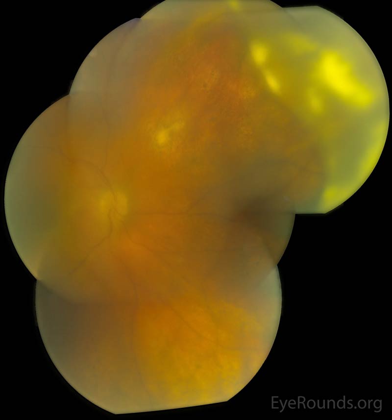Color fundus photo montage part-way through the treatment course demonstrating improved media opacity and yellow-white colored pre-retinal opacities nasally and inferiorly 