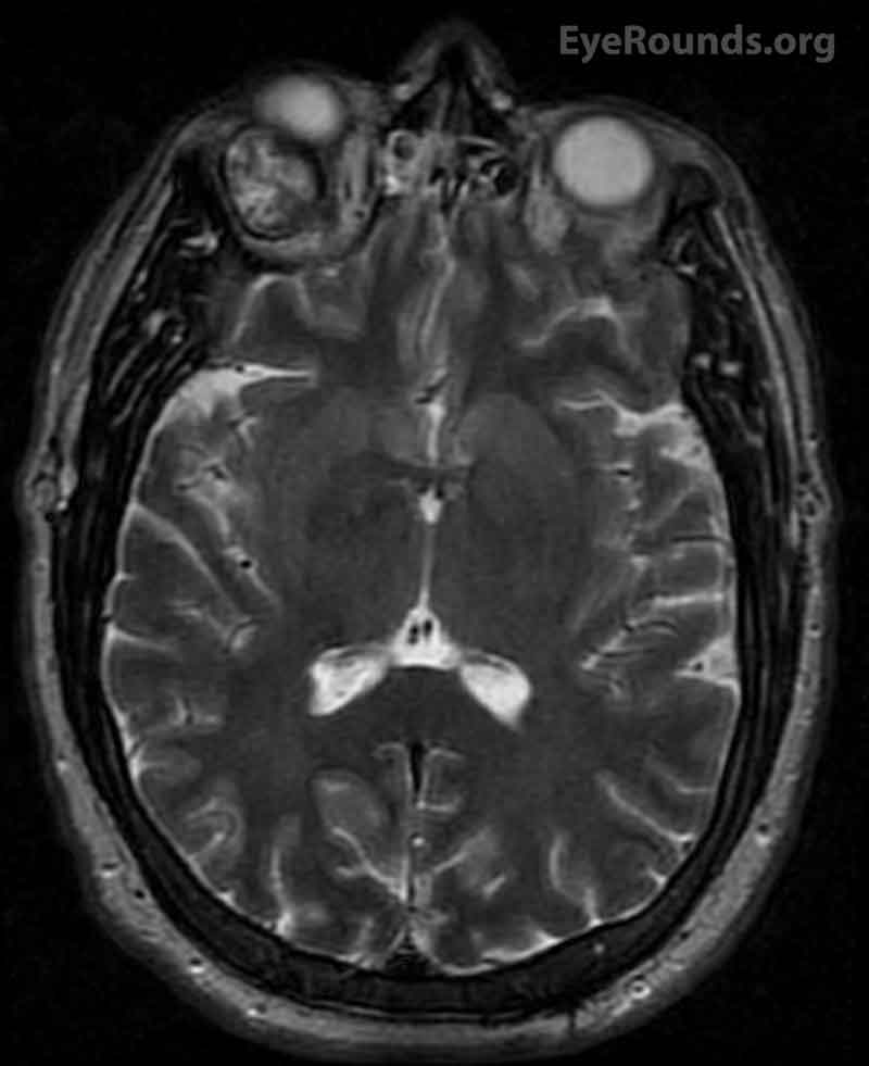 T2 weighted MRI image, axial view 