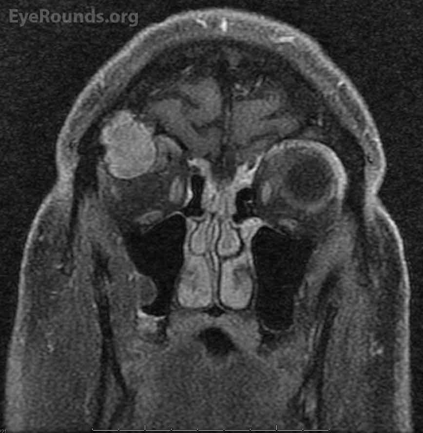 T1 weighted (fat saturated) MRI image, coronal view