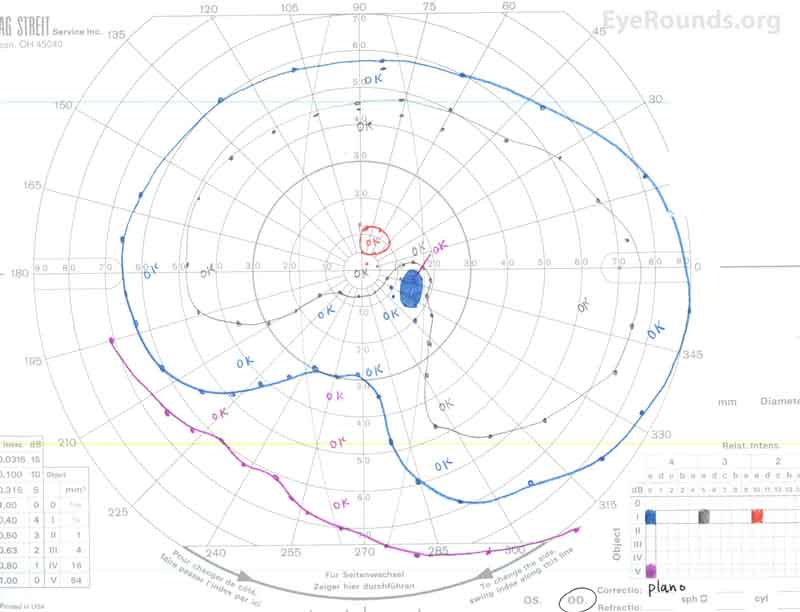 Goldmann visual field of the right eye showing inferonasal depression of all isopters.  