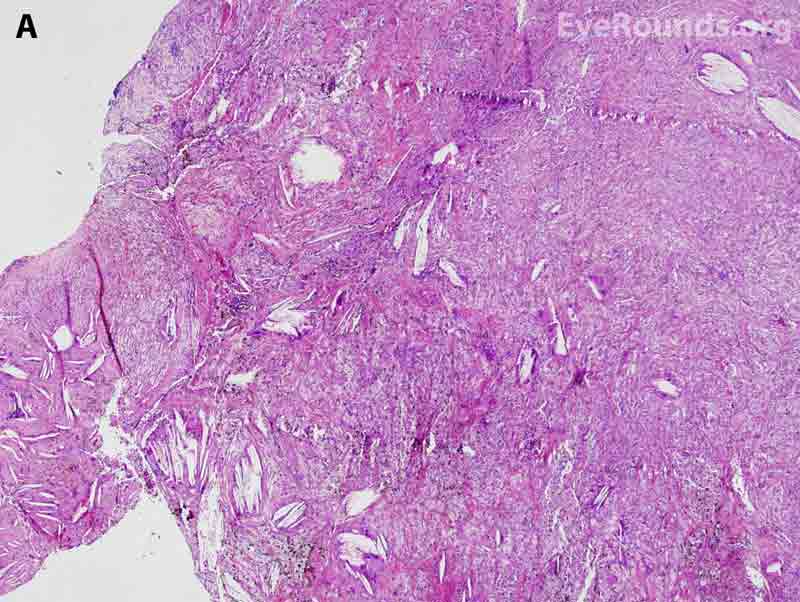 Hematoxylin-eosin stained histopathology demonstrating numerous cholesterol crystal clefts, surrounding multinucleate giant cells, epithelioid histiocytes, and foamy macrophages, all of which are consistent with a cholesterol granuloma, 4x magnification