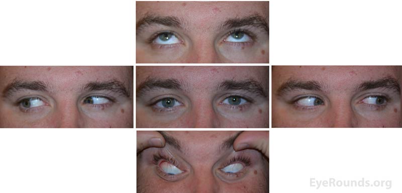 Postoperative photos demonstrating no limitation in motility and resolution of the right hypoglobus. 