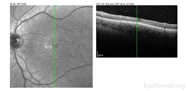 OCT OD (A) and OS(B) show diffuse retinal thinning with parafoveal atrophy of the outer retinal layers.  There is an area of subfoveal hyperreflective foci OU. 