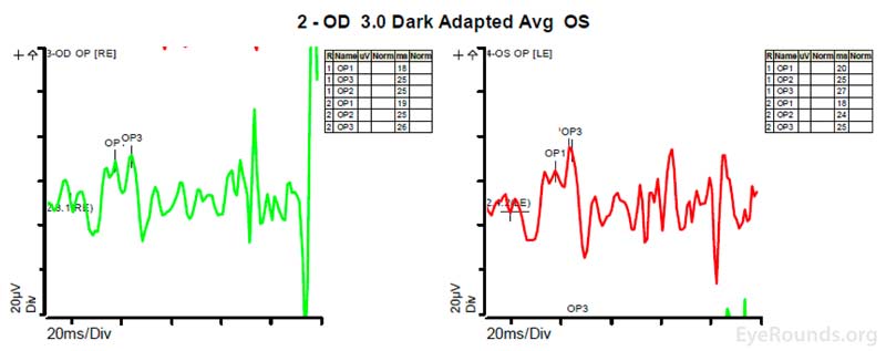 Figure 4B shows dark adapted 3.0 cd.s/m2 oscillatory potentials which are anomalous in configuration.