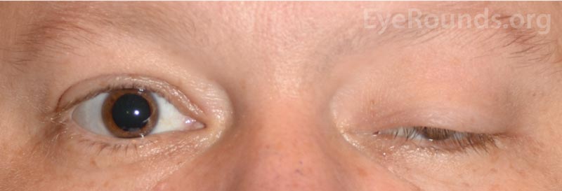 External photo was notable for left-sided ptosis accompanied by proptosis
