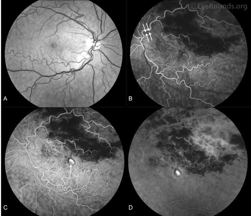 Fundus fluorescein angiography (FFA), both eyes: A. There was no evidence of vasculitis or leakage in the right eye. B-D. In the left eye, there was attenuation of the superotemporal veins (B), early staining of the central lesion (C, arrow) with late leakage (D), prominent superotemporal leakage (D), and no leakage inferotemporally. There was blockage superotemporally corresponding to the intraretinal hemorrhages. There was decreased perfusion and capillary remodeling of the far superotemporal peripheral vasculature (C and D).