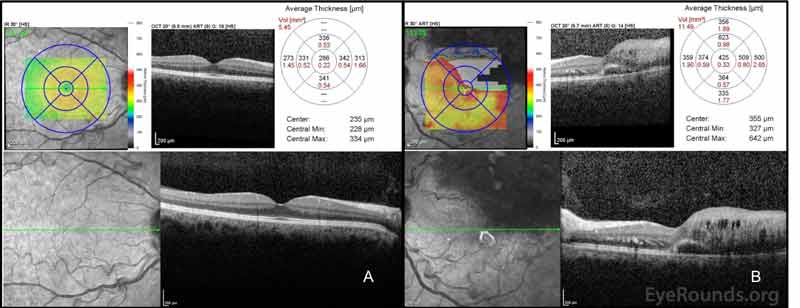 Optical coherence tomography (OCT): A. In the right eye, the central macular thickness (CMT) was 286 microns with a normal foveal contour. B. In the left eye (OS), the CMT was 425 microns with marked cystoid macular edema superiorly with subretinal fluid superiorly and temporally. Not depicted here is a pigment epithelial detachment inferior to the fovea with isodense material OS.